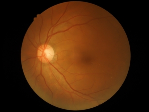 Central Retinal Artery Occlusion