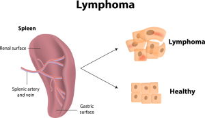  Lymphomas