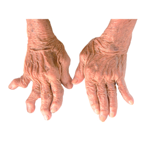  Symptoms of Rheumatoid Arthritis