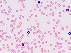  Anemia Due to Hemolysis