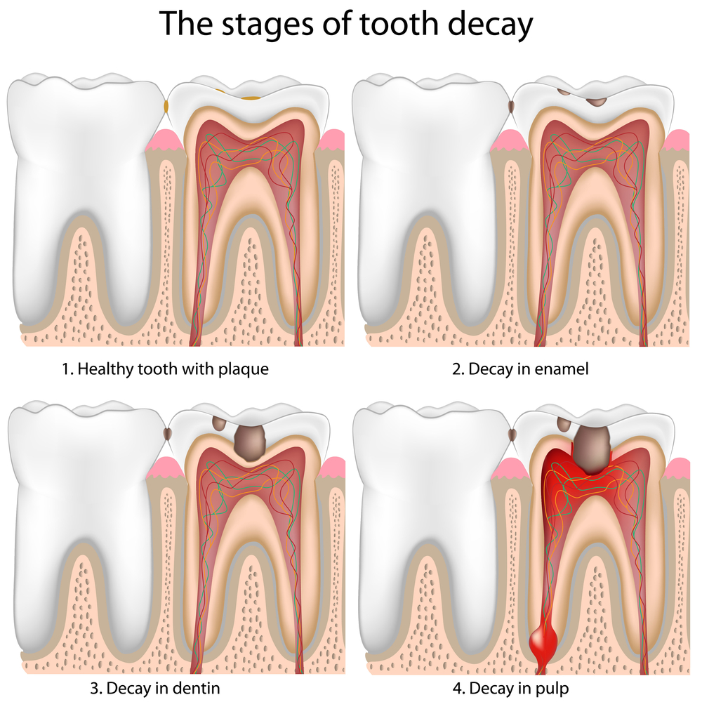 Tooth Infection Net Health Book