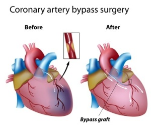 Treatment of Heart Attack (Bypass Surgery)