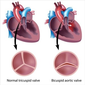  Aortic Valve Disease