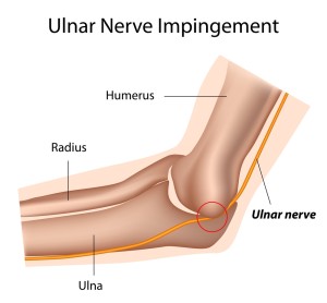 Cubital Tunnel Syndrome (Course Of Ulnar Nerve)