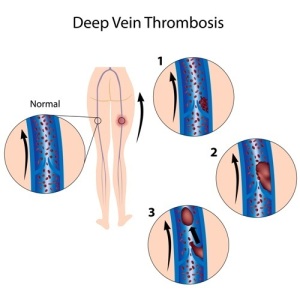 Cardiovascular System After Delivery (Deep Vein Thrombosis Risk Higher After Delivery)