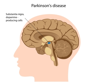  Parkinson’s Disease