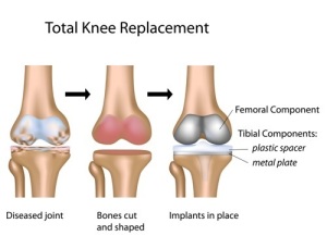 Treatment of Osteoarthritis (Total Knee Replacement)