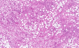  Cryptococcosis (Lung biopsy In AIDS Patient With Large, Pale Cells Being Cryptococcus Neoformans)