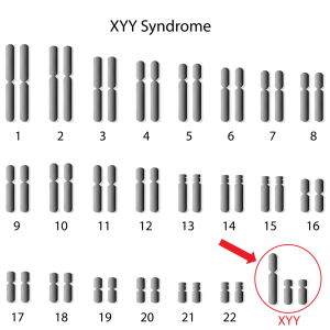  47XYY Syndrome