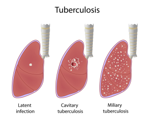  Miliary Tuberculosis