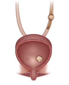  Ureteritis (With Kidney Stone)