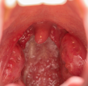  Diphtheria (Acute Membranous Tonsillitis)