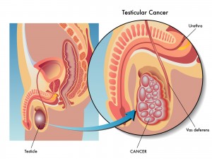 Germ Cell Tumors And Testicular Cancer