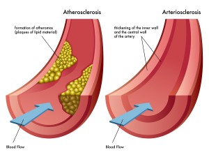 Hardening Of Arteries Reversed With Supplements