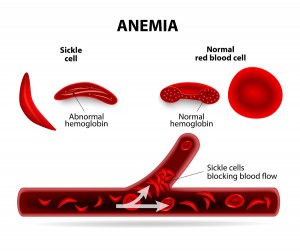 Sickle Cell Disease Cured