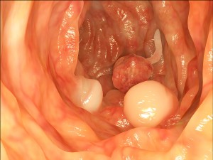 Colon Cancer Risk Reduced In Two Weeks
