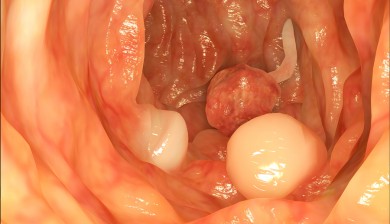 Colon Cancer Risk Reduced In Two Weeks