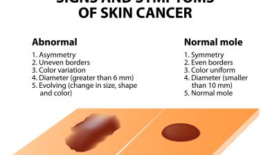 High-Tech Tool To Screen For Skin Cancer