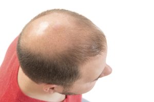 Early Graying And Baldness Predict Heart Disease
