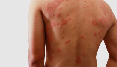 Are Your Clothes Giving You A Skin Rash?