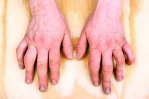 Inflammation In Rheumatoid Arthritis Patients Affects The Brain