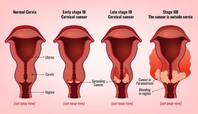 Minimally Invasive Cervical Cancer Surgery