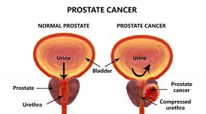 Blocking Saturated Fatty Acids May Help Patients With Prostate Cancer