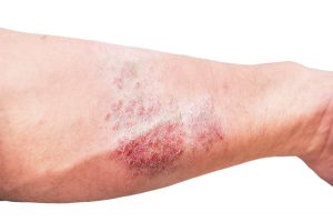 A New Drug That Cures Eczema In One Day