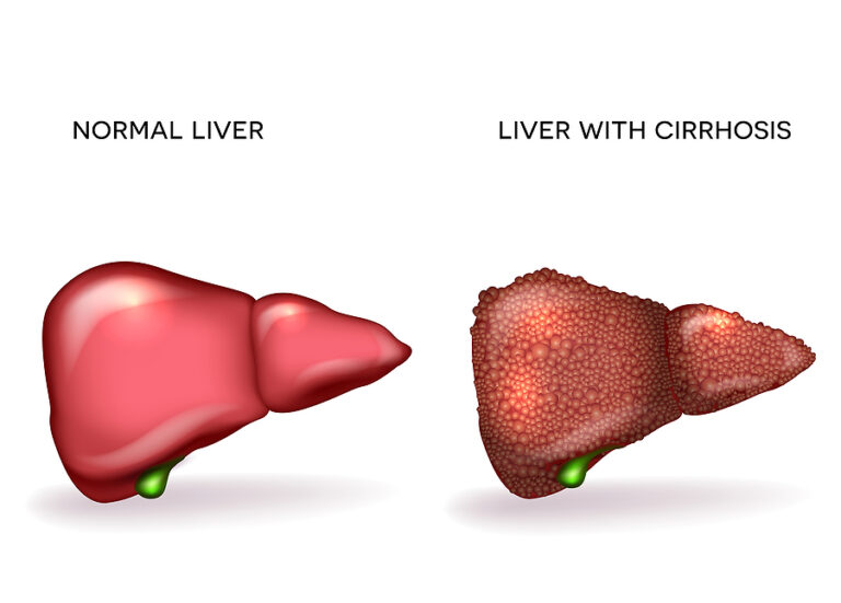 hepatitis C can lead to cirrhosis of the liver