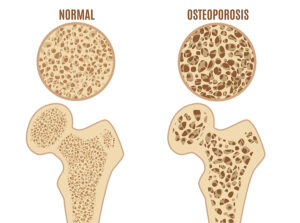 Causes Of Osteoporosis