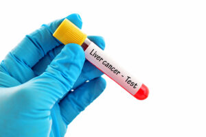 Diagnostic Tests For Liver Cancer