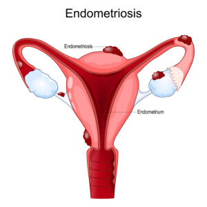Help for Endometriosis