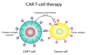 Cure for Lupus with CAR T-Cell Therapy
