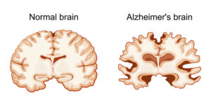 New Alzheimer’s Treatment