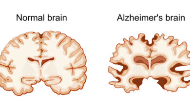 New Alzheimer’s Treatment